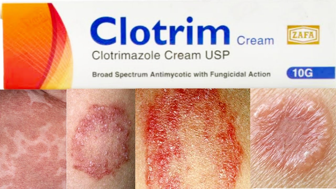 Eczemar + Anti Fungal cream  – Doctor’s Recommended